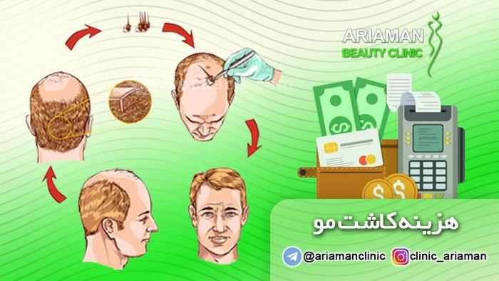 هزینه کاشت مو در ایران چقدر است ؟؟